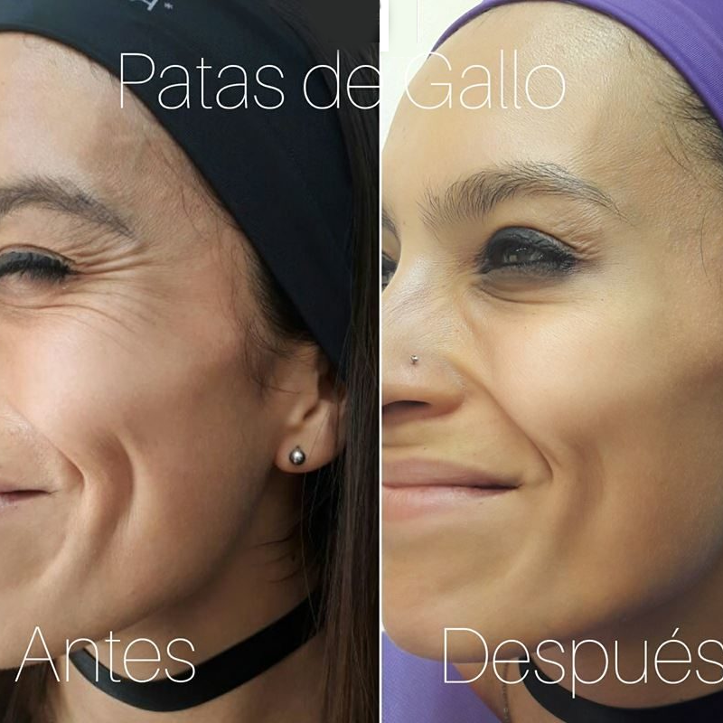 Gel de Ácido Hialurónico